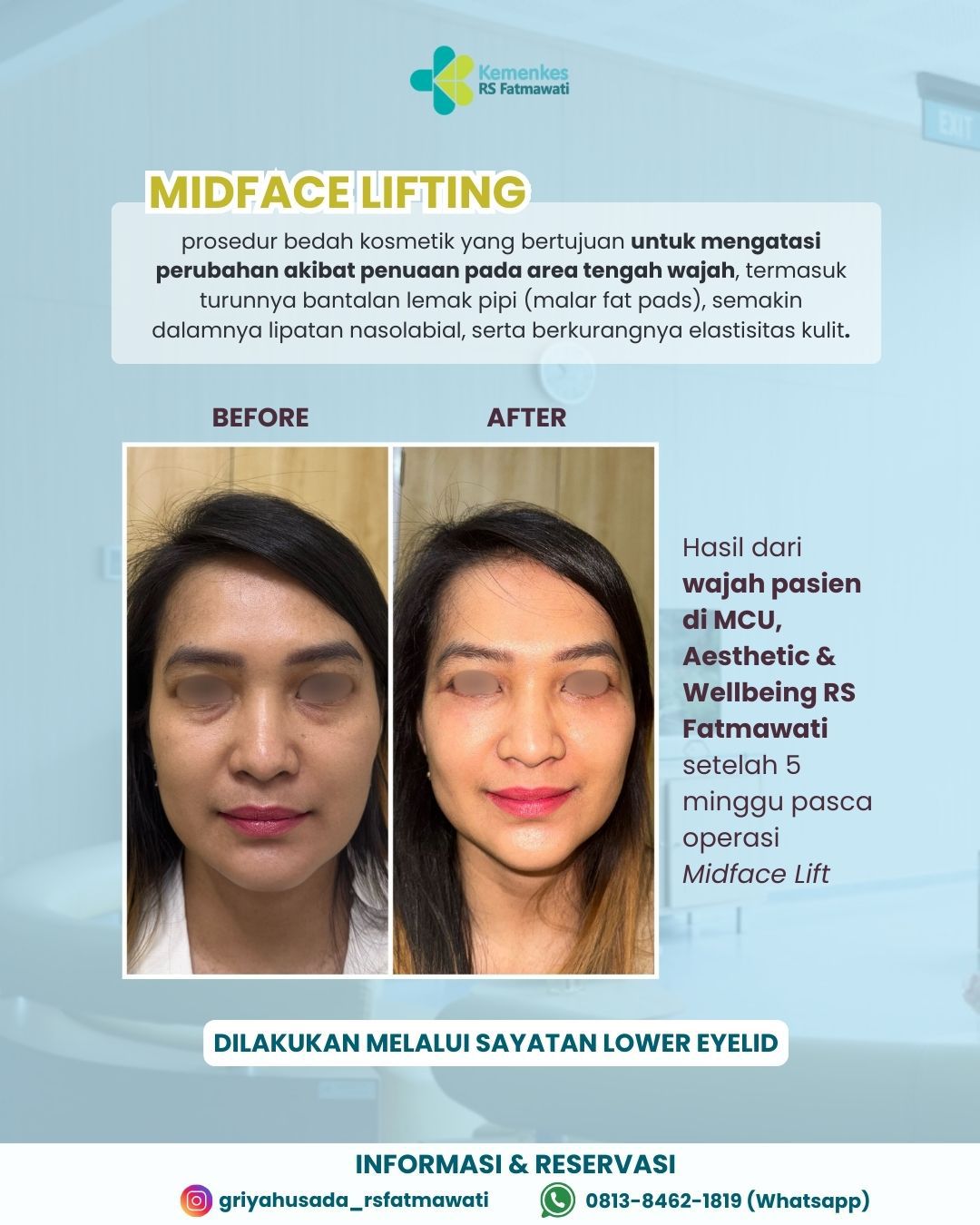 Midface Lifting, Solusi untuk Kesegaran Wajah Anda 